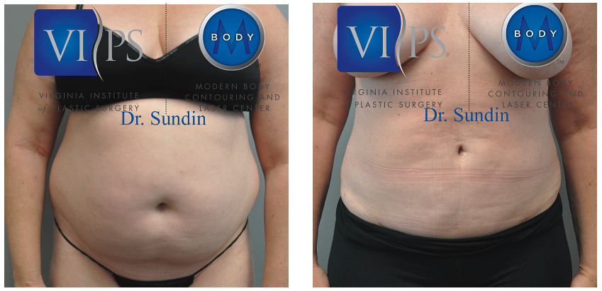 before and after lipo